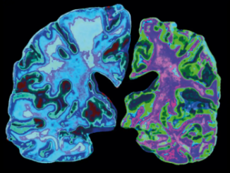 Alzheimer’s disease has destroyed neurons in the right-hand brain above. Jessica Wilson/Science Photo Library/New Scientist