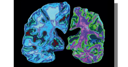 Alzheimer’s disease has destroyed neurons in the right-hand brain above. Jessica Wilson/Science Photo Library/New Scientist